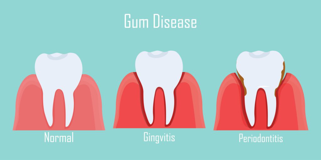 treatment for gum disease in rosedale md