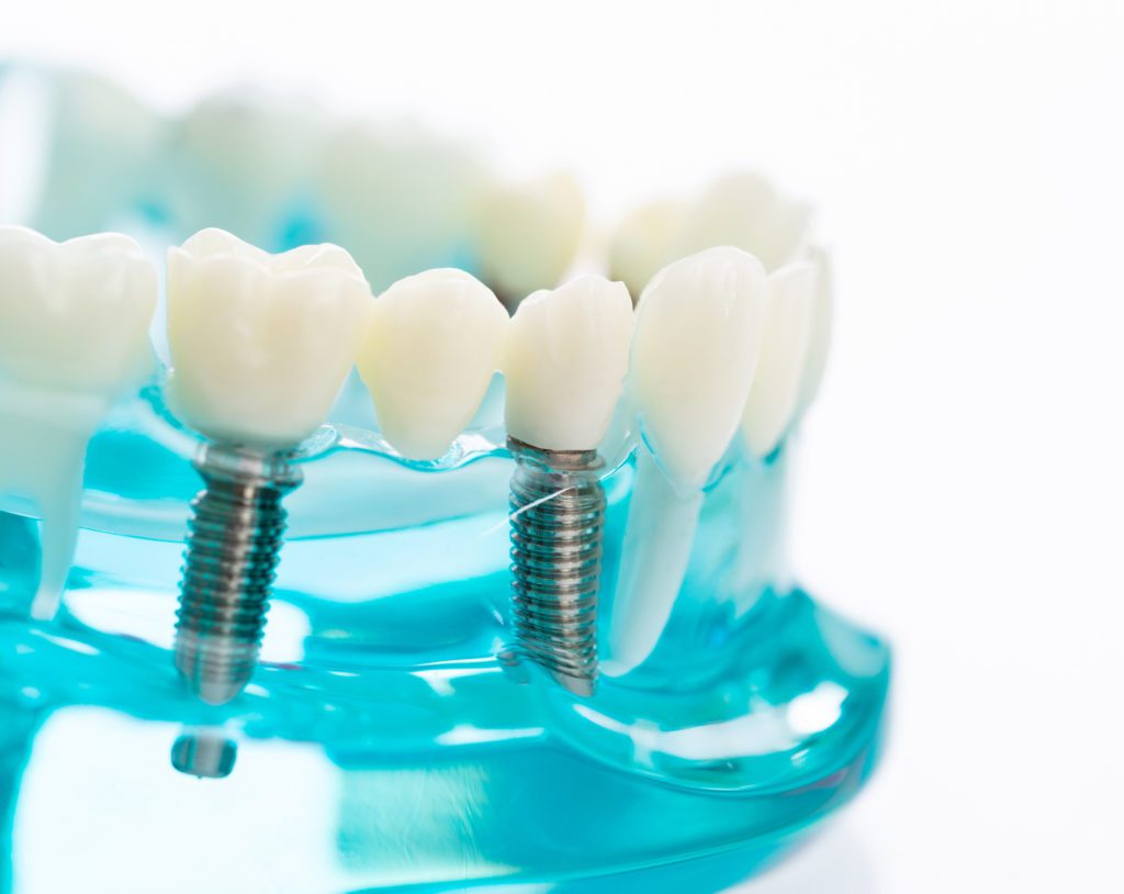 Dental Implant Treatment in Rosedale, Maryland